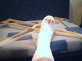 130509_gips_perelom_noga.jpg